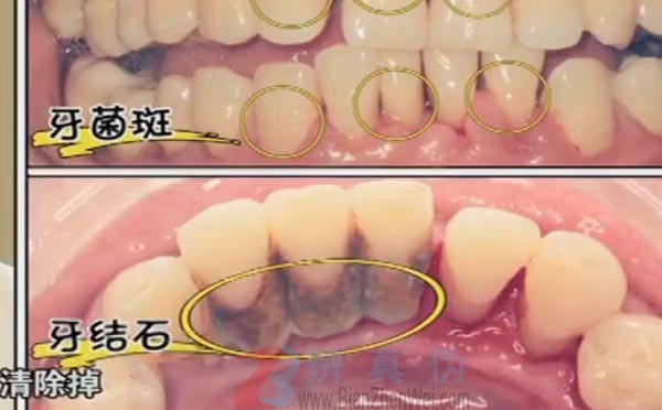 牙龈出血是因为体内缺少维生素C是网络谣言。是牙周疾病最早期的一个信号——辨真伪网