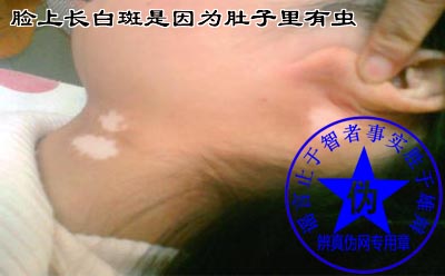 脸上长白斑是因为肚子里有虫是网络谣言。提醒如果孩子脸上长白斑在未确诊的情况下，还要及时到医院进行明确的鉴别诊断，避免因不对症用药而给孩子造成了伤害——辨真伪网